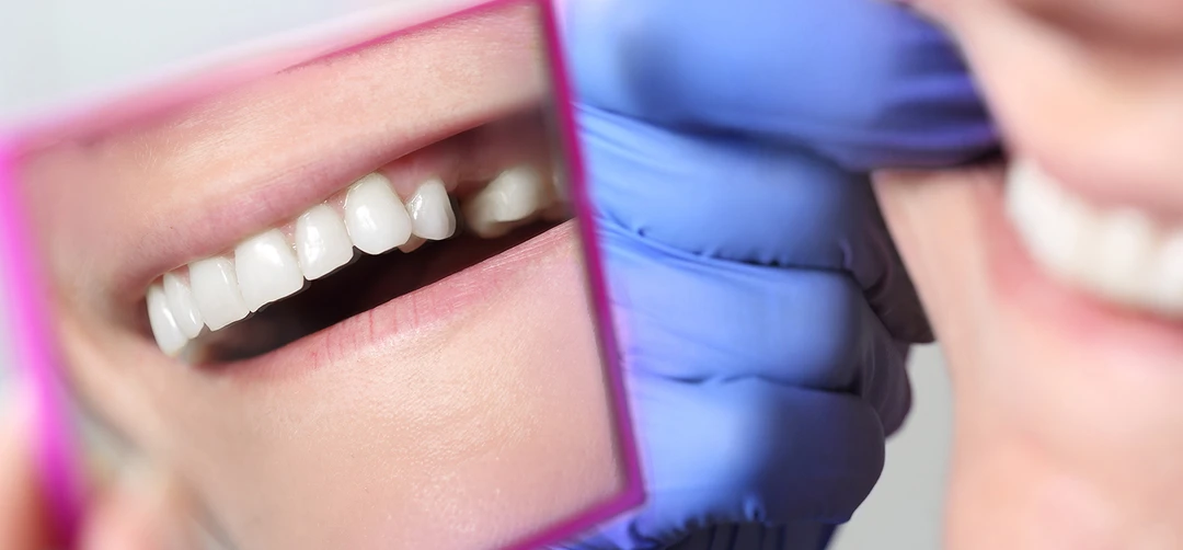 dental bridges near you