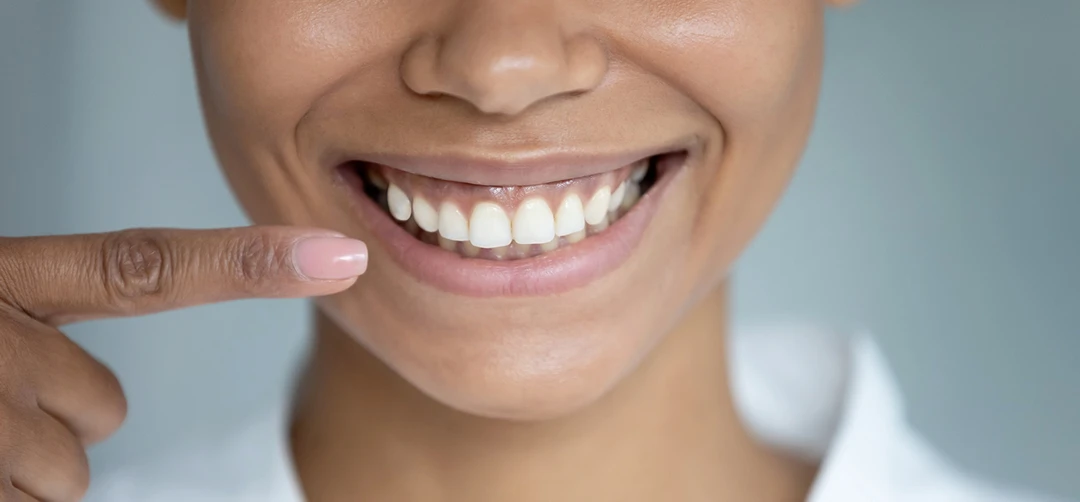 dental crowns carrollwood