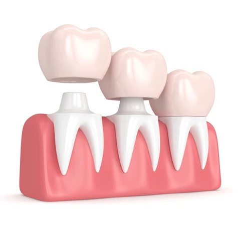 Our dental crowns in Carrollwood
