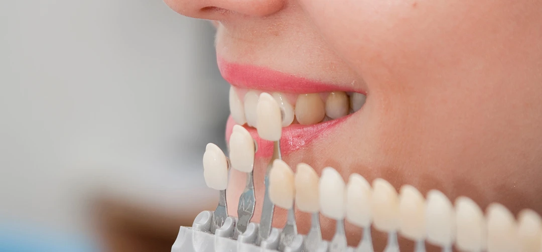 dental veneers near me