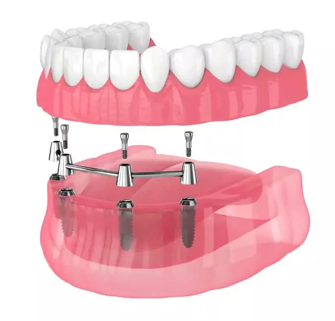 Full Arch dental implants