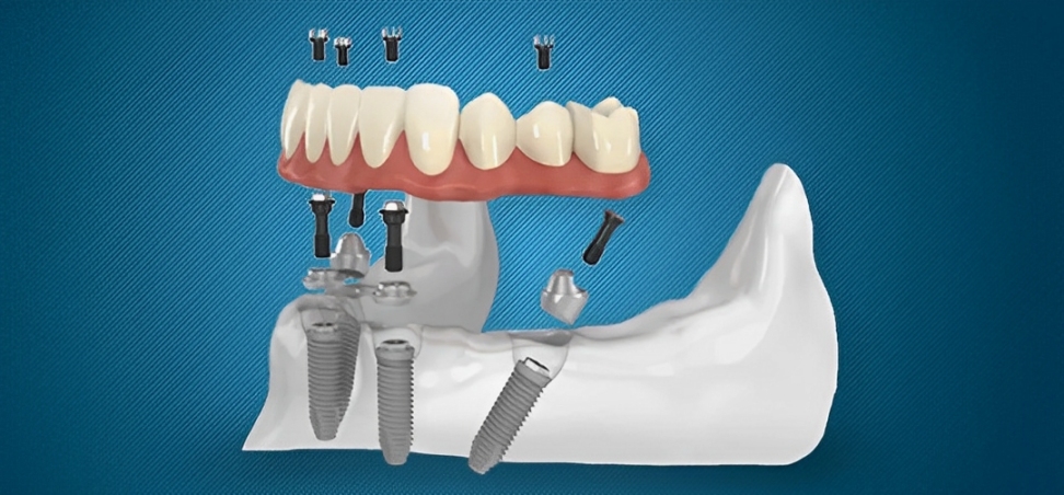 full arch dental implants in carrollwood