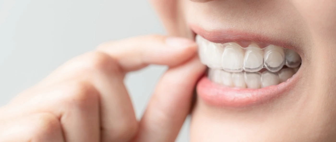 invisalign near you