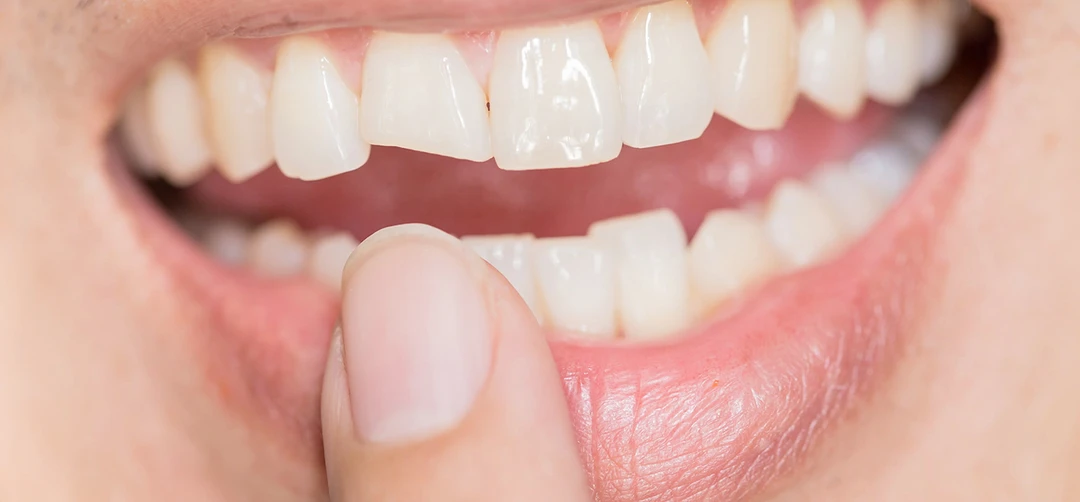 smile makeover carrollwood