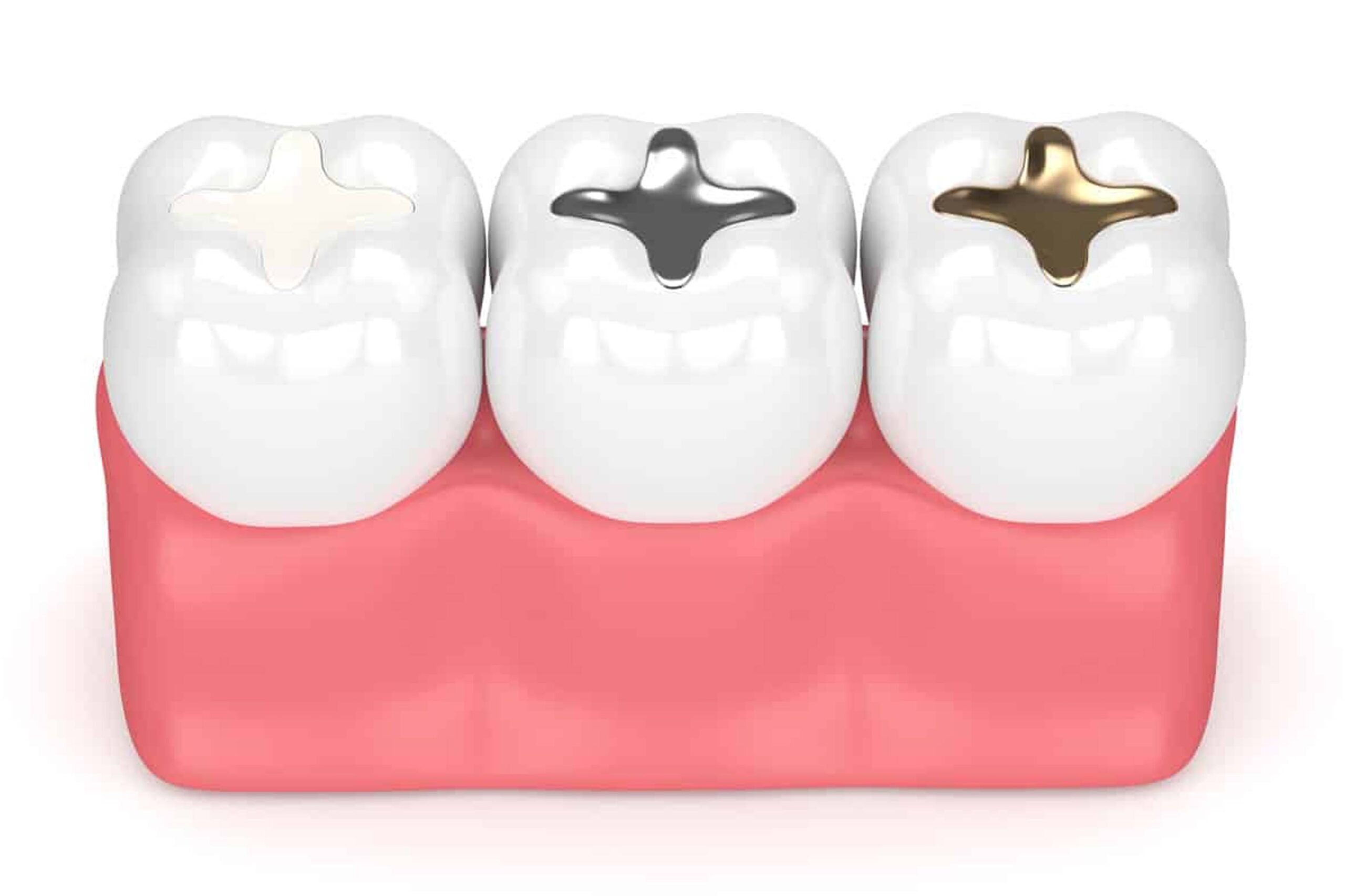 Types of Teeth Fillings: Which Color is Right for You