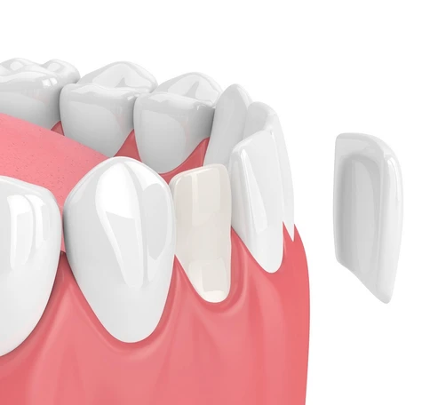 dental veneers