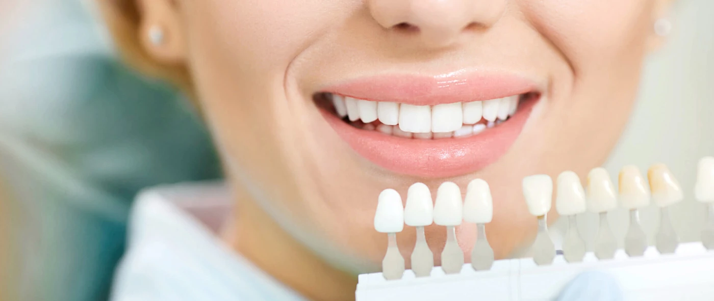 dental veneers in Carrollwood