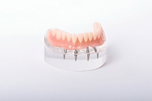 Full-Arch Dental Implants IN CARROLLWOOD