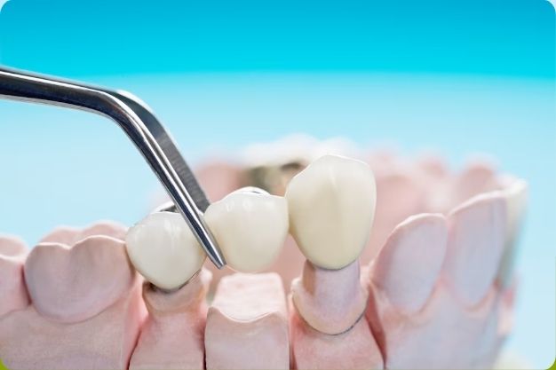 Oral hygiene with dental crowns
