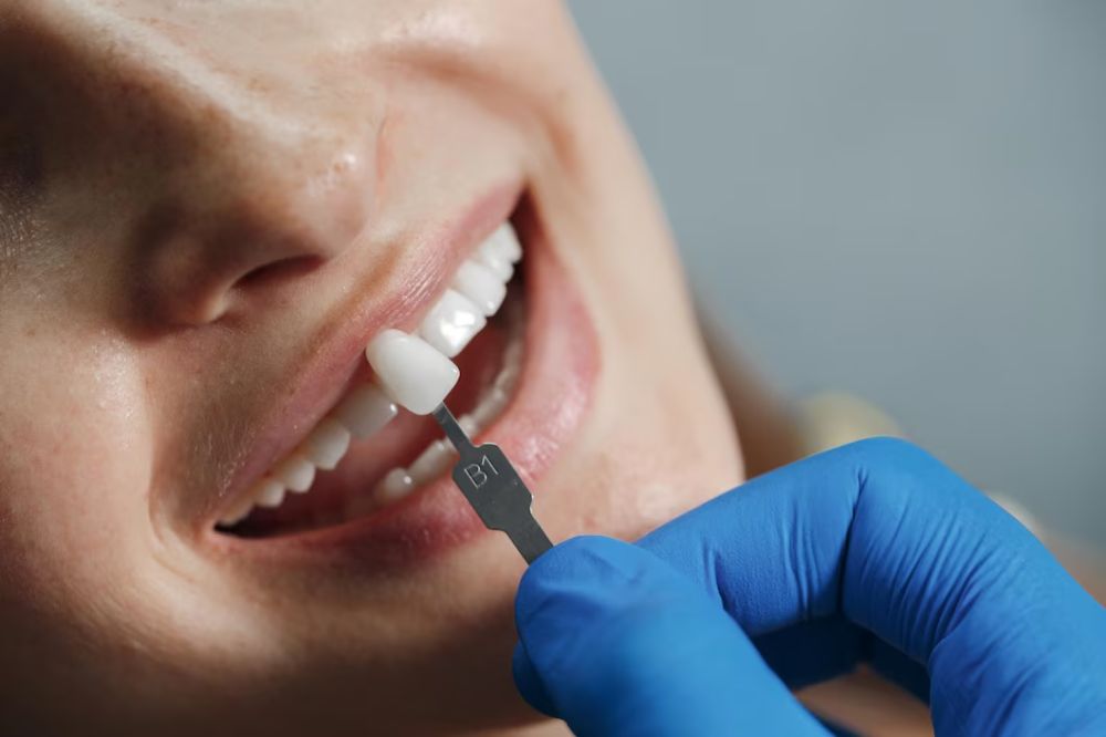 do dental veneers look natural when covering gaps