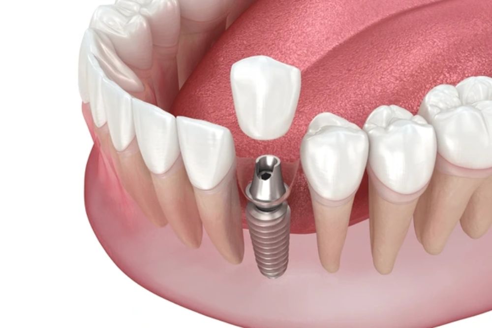 how to replace a single tooth with a dental implant