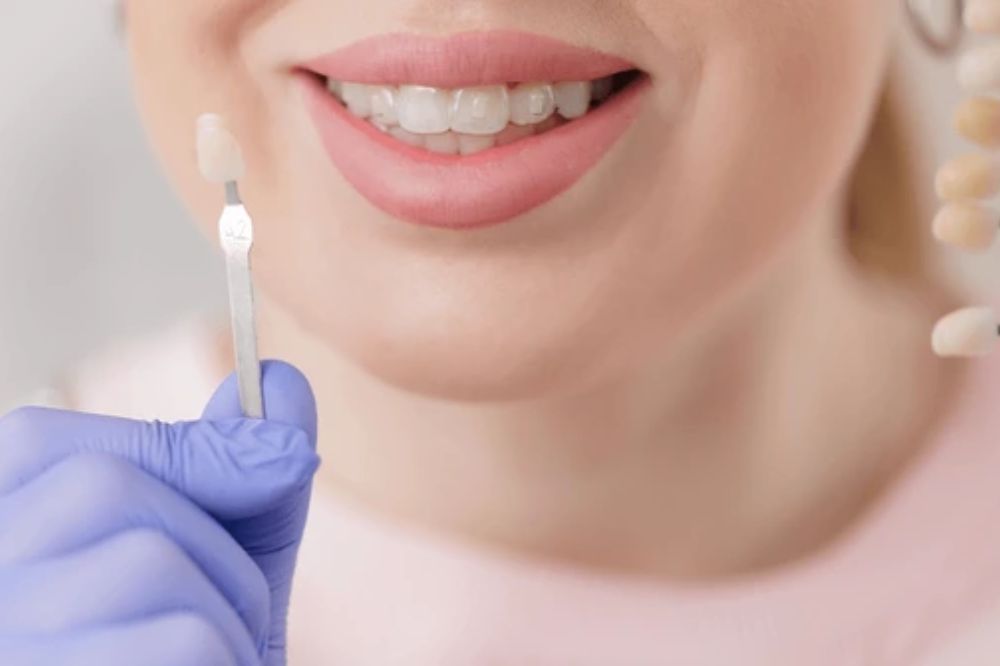 how long do dental veneers last maintenance and longevity tips